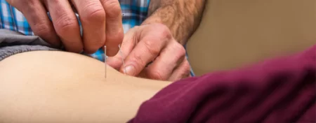 Dry-Needling-Excel-Physical-Therapy-Oshkosh-WI