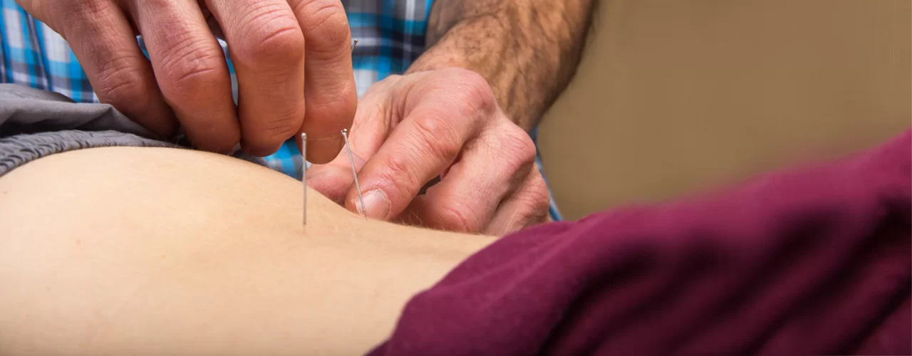Dry-Needling-Excel-Physical-Therapy-Oshkosh-WI
